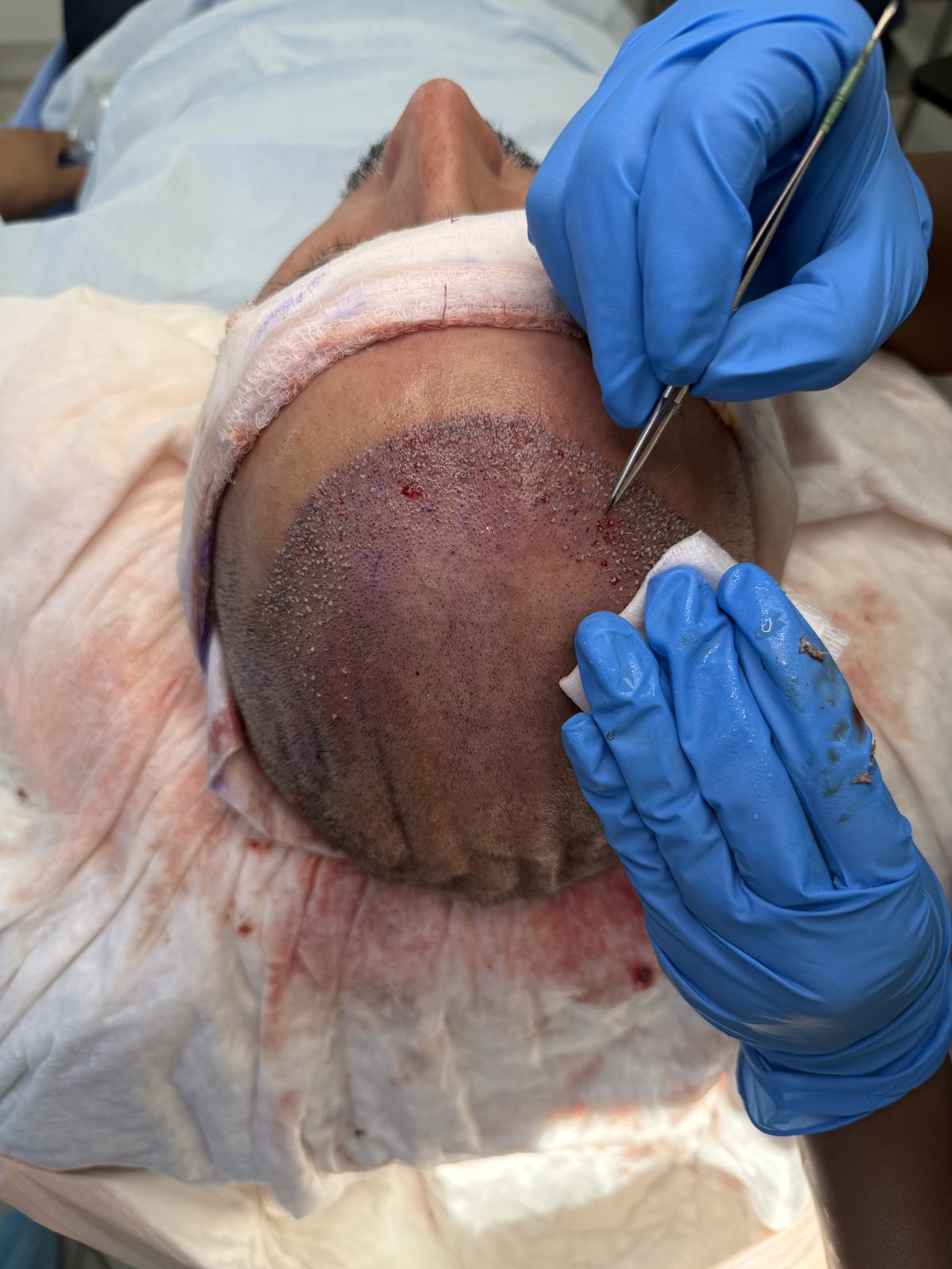 Surgeon performing an FUE hair transplant procedure at Tran Plastic Surgery