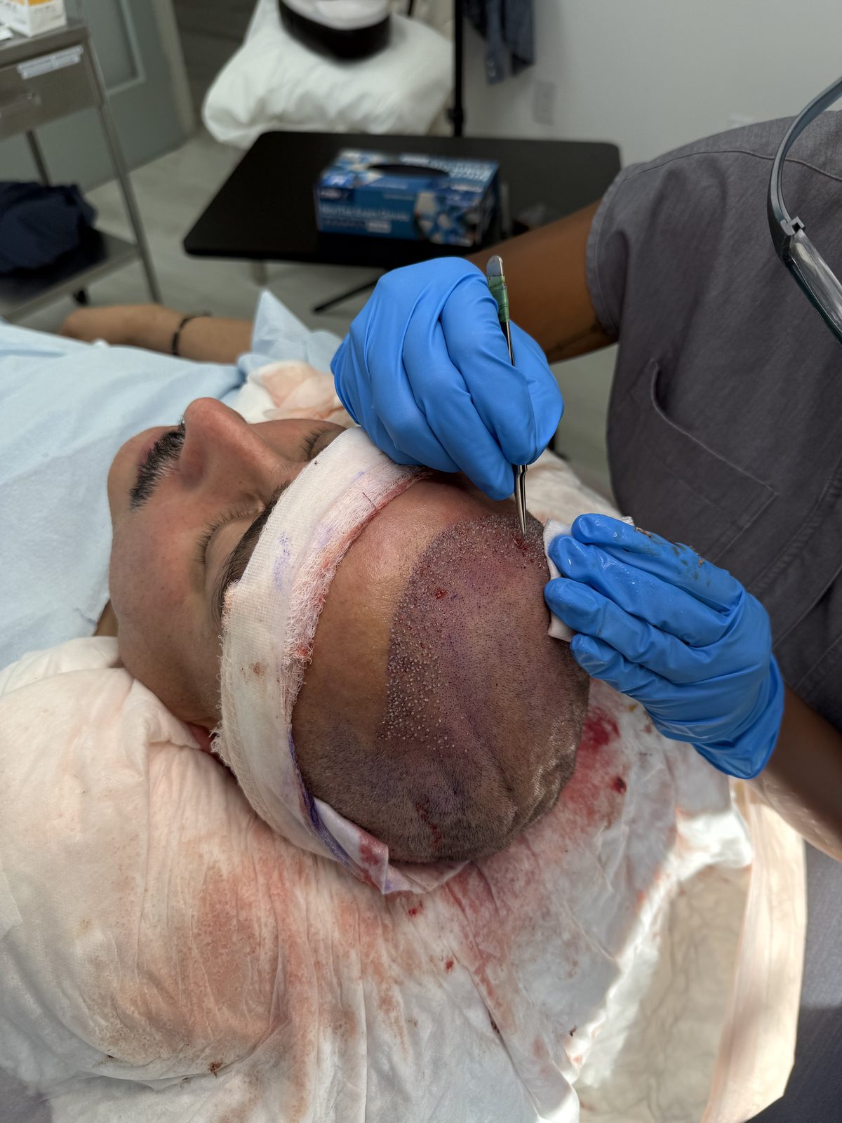 FUE hair transplant procedure at Tran Plastic Surgery in Huntington Beach