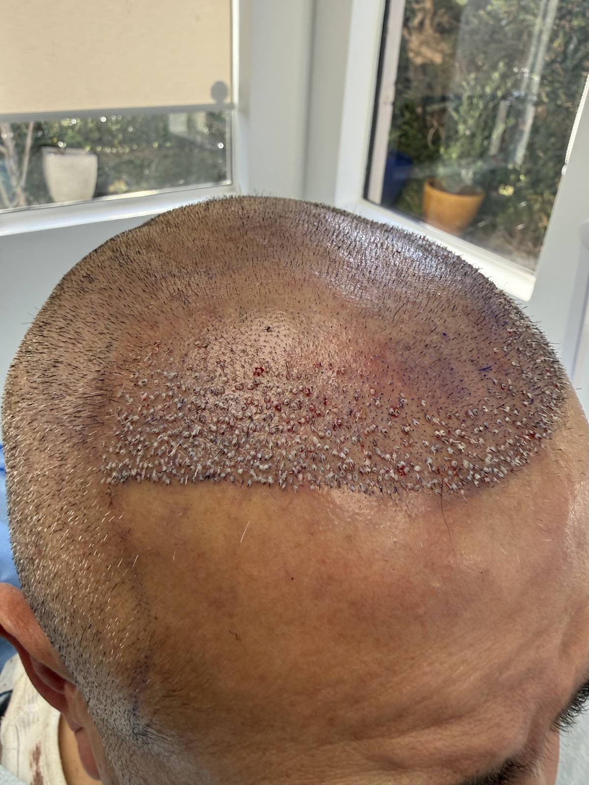 Frontal view of the scalp after an FUE hair transplant procedure
