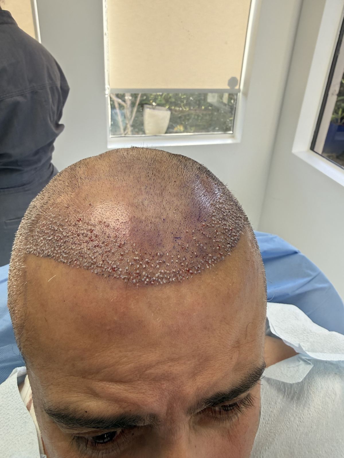 Frontal hairline after an FUE hair transplant procedure at Tran Plastic Surgery in Huntington Beach