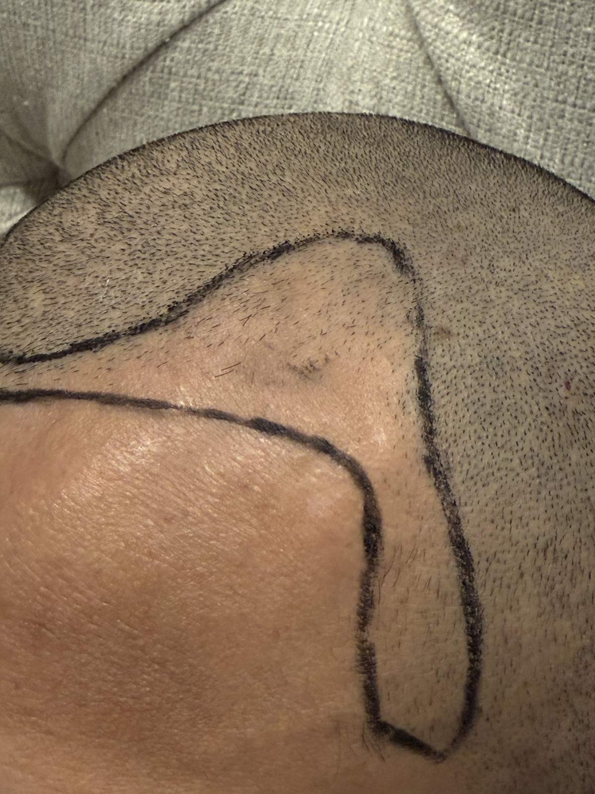 Hairline and temple design markings for an FUE hair transplant