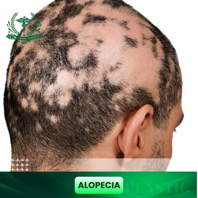 Alopecia
