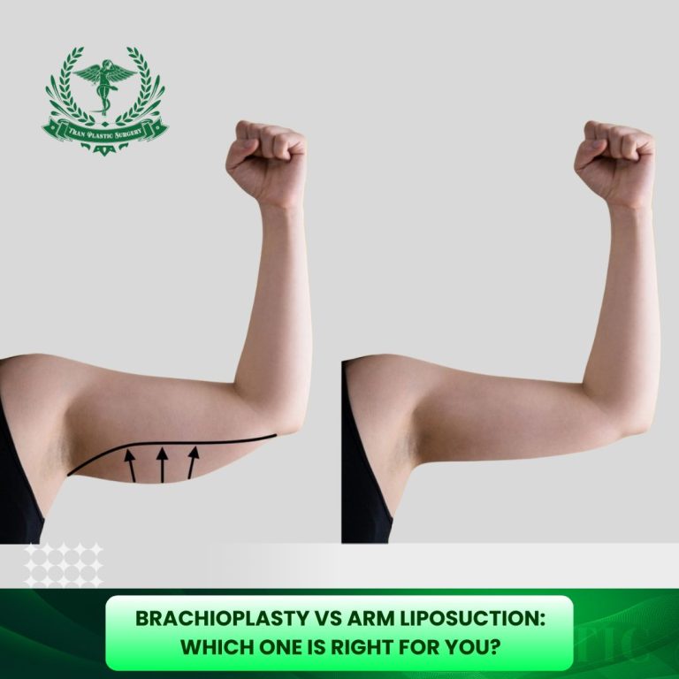 Brachioplasty vs. Arm Liposuction