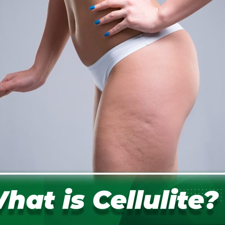 cellulite