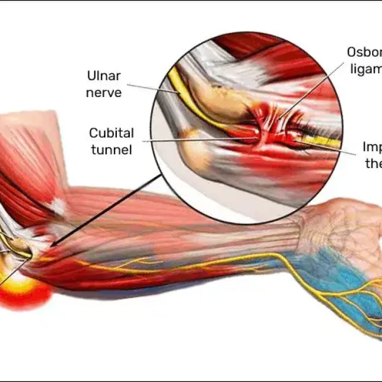 Cubital-Tunnel-Syndrome