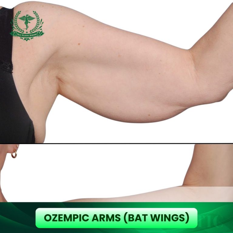 Ozempic Arms (bat wings)