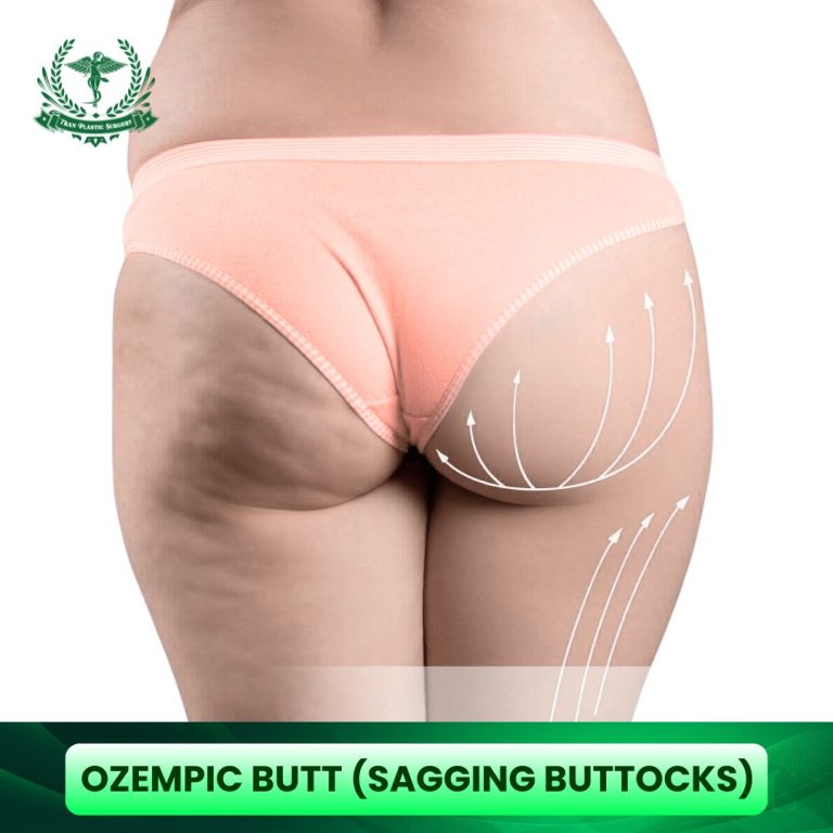 Ozempic Butt (sagging buttocks)