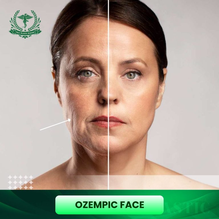 Ozempic face