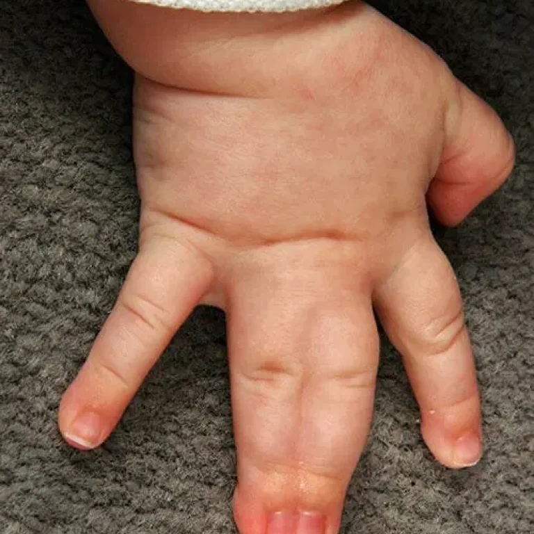 Patient-Education_Syndactyly-1