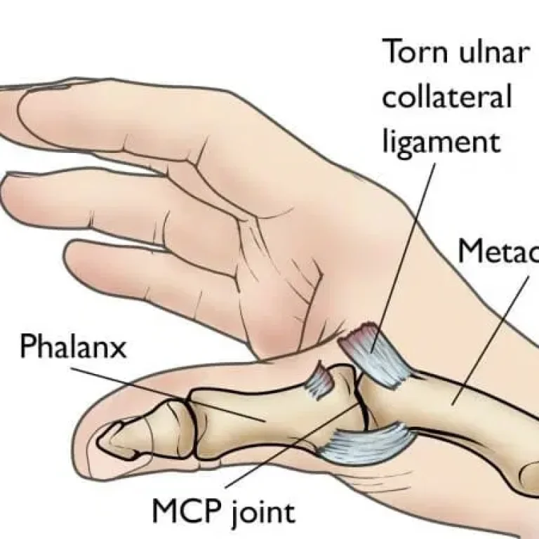 Patient-Education_Thumb-UCL-Tear