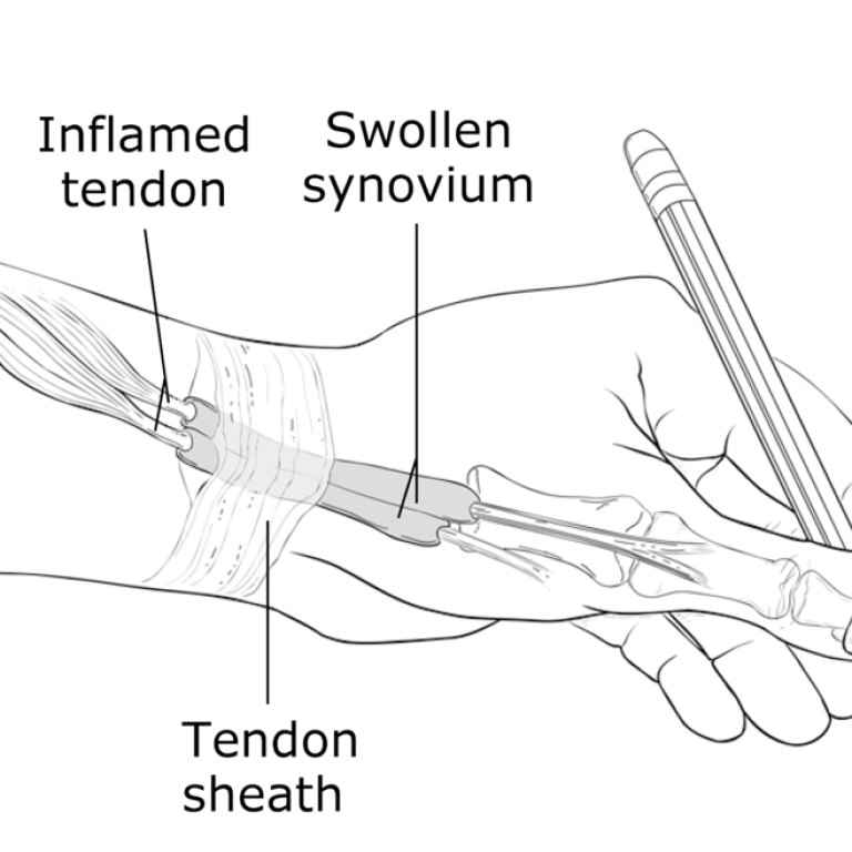 Radial-Styloid-Tenosynovitis-892x658