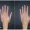 Restylane-fillers-for-the-hands