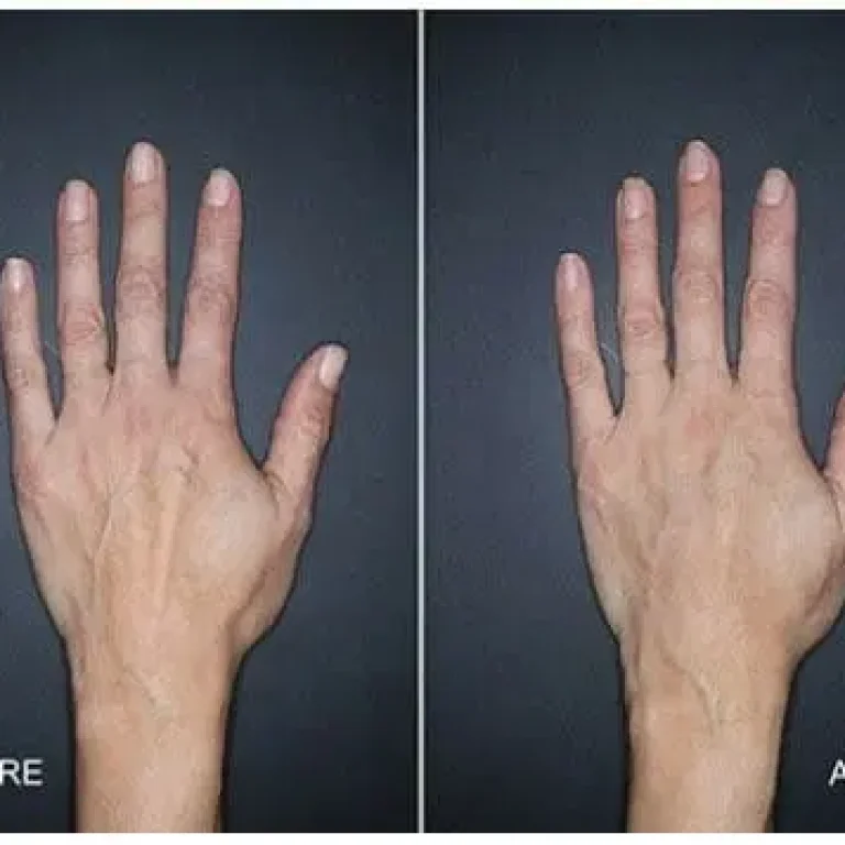 Restylane-fillers-for-the-hands