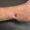 Scaphoid-Fracture-of-the-Wrist