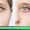 blepharoplasty-01