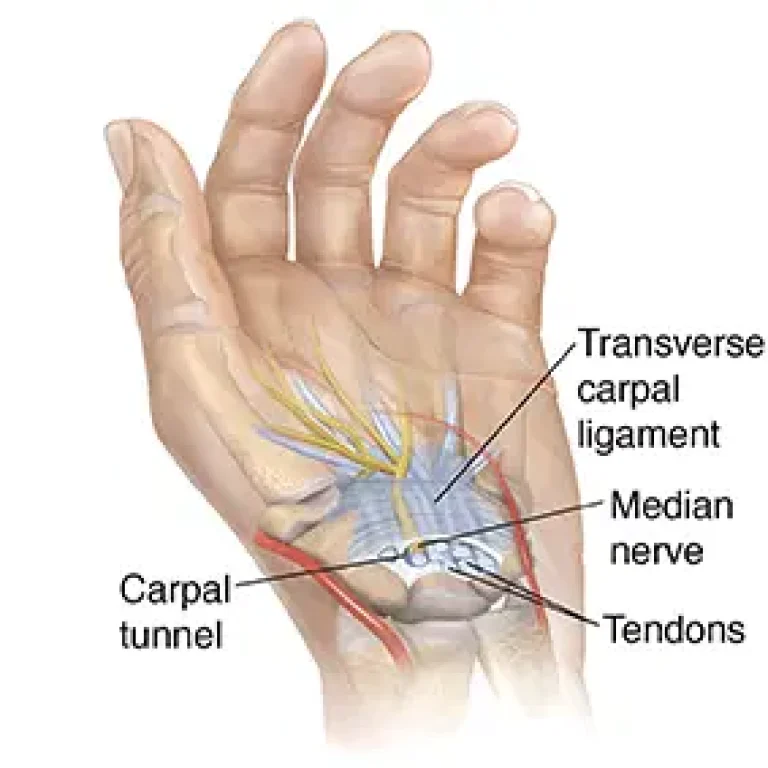 carpal-tunnel