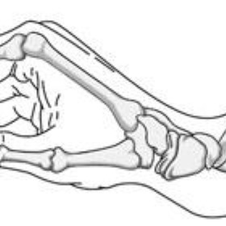 distal-radius-fracture