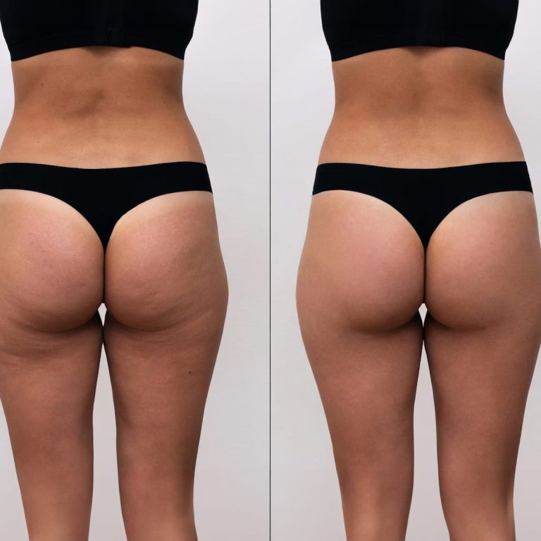 Enhance Your Curves with Butt Lift Surgery