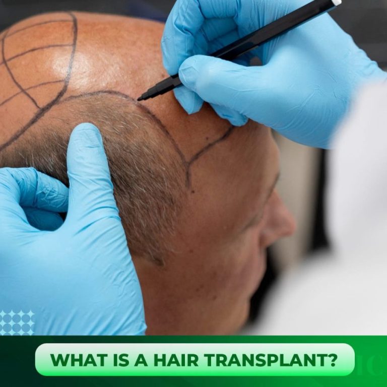 hair-transplant-01
