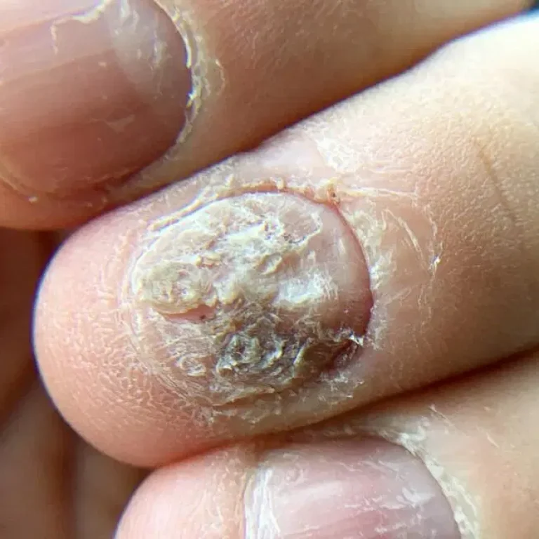 nail-fungus-1100x658