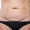 post-lipo-1024x658