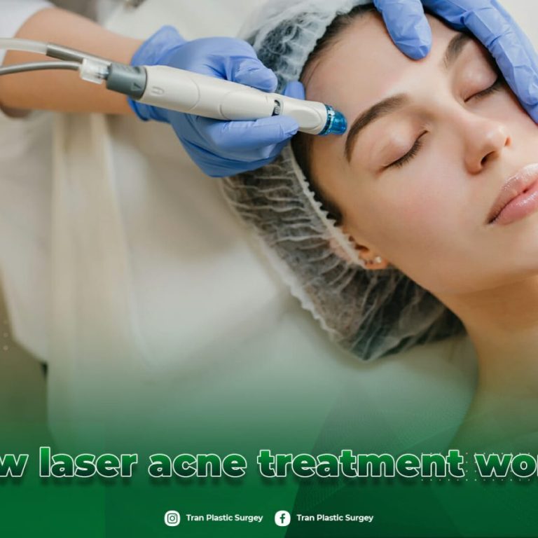 power-of-laser-acne-treatment