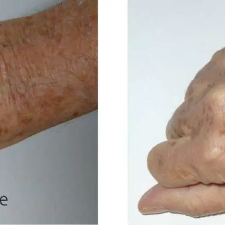 surgical-handlift-1170x434